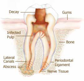Root Canal Colgate Aetna