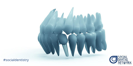 3 reasons why dental implants are better than dentures