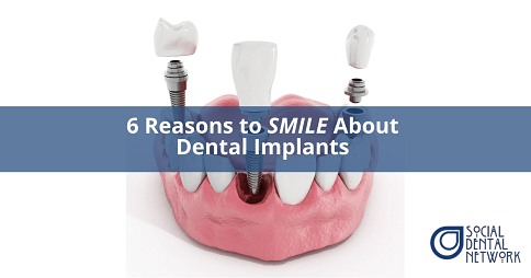 6 Reasons to SMILE About Dental Implants 